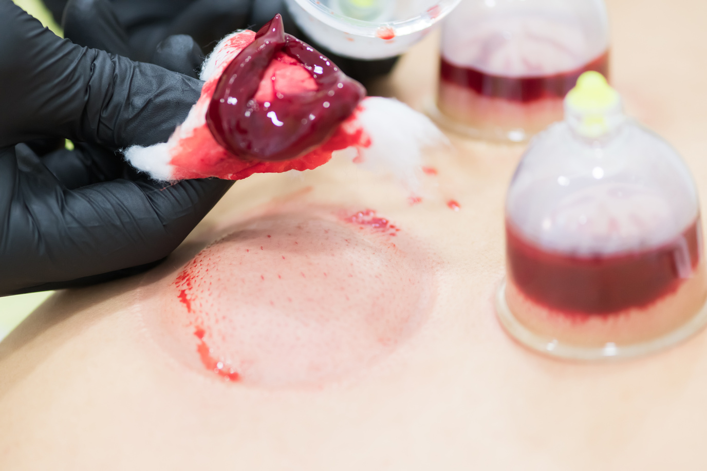 Close up of young person doing hijama treatment. Blood cleaning process.