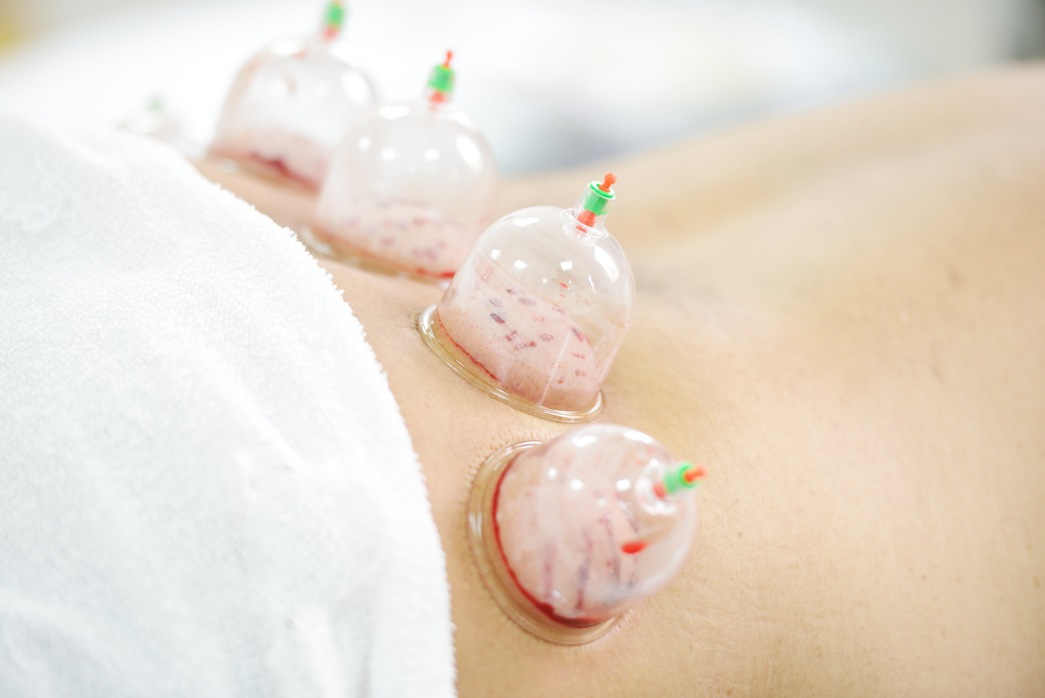 Medical Hijama Cupping Therapy